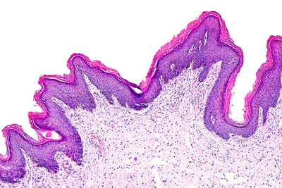 Immagine di una biopsia effettuata da Gynecolab